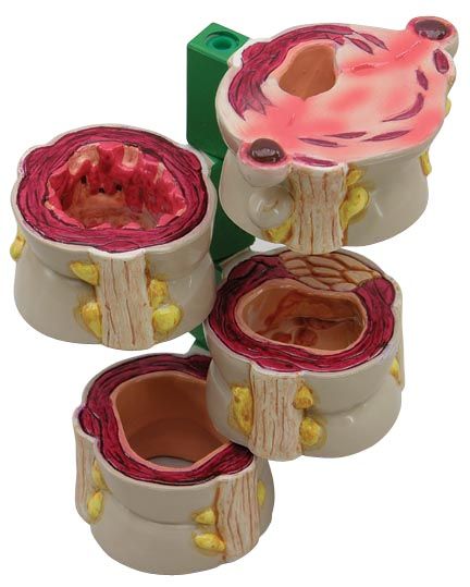 Piece Colon w/ Pathologies Medical Model GPI 3341